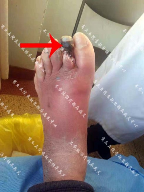 一个脚趾干性坏疽因治疗不当面临截肢的中西医结合保肢保守治疗案例