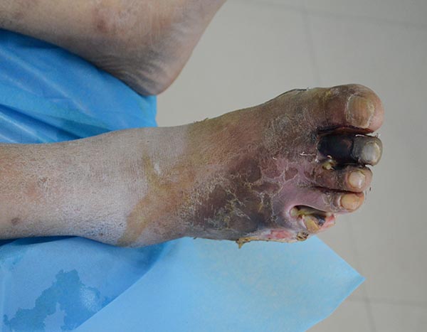 案例：糖尿病患者因为脚脱皮处理不当出现伤口，脚趾坏死的保守不截肢治疗