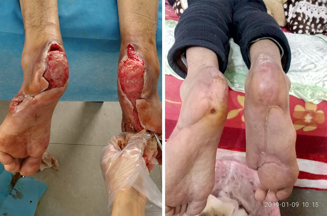 袁敏琴：糖尿病人脚烫伤起水泡用烫伤膏很可能会导致截肢！
