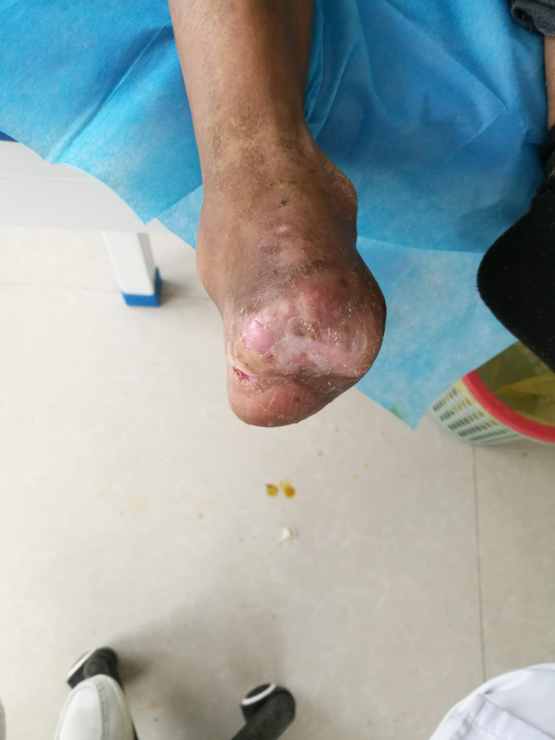 图 上图病人不但脚趾发黑坏死，半个脚掌都坏死了，所有医院都要求膝关节截肢