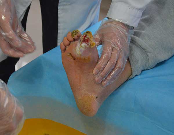 糖尿病人脚上的伤口流脓为什么一直在加重？怎么才能治好？