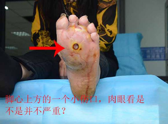 典型案例：糖尿病脚上只是一个小伤口，为什么一直流脓肿胀疼痛厉害？
