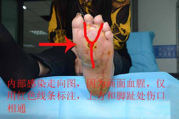 典型案例：糖尿病脚上只是一个小伤口，为什么一直流脓肿胀疼痛厉害？