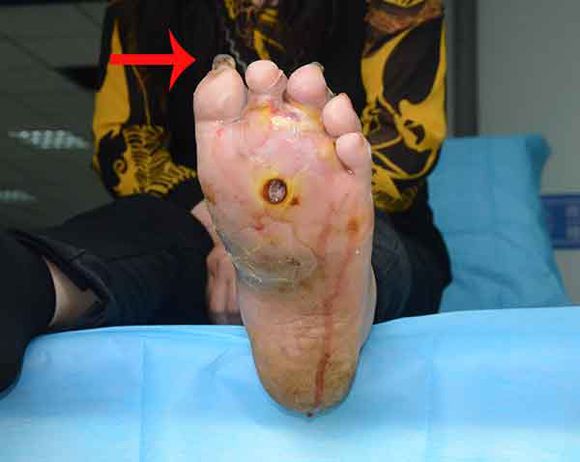 糖尿病患者的脚趾甲变厚与糖尿病足之间有关联吗？