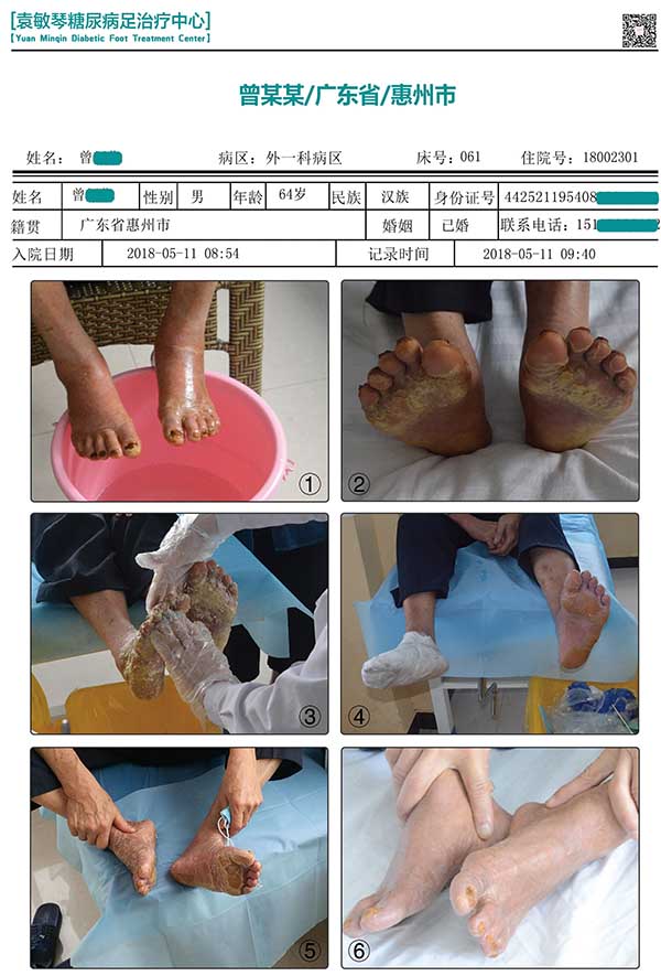 袁敏琴：导致糖尿病烂脚的原因都有哪些？