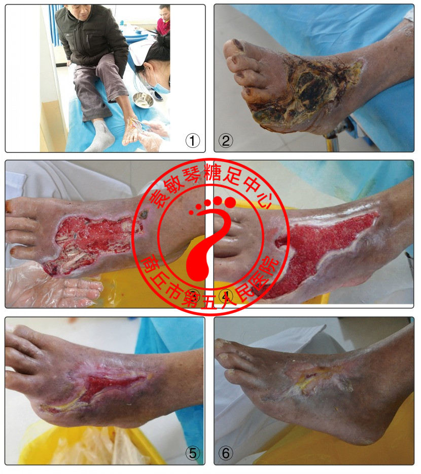 脚趾缝伤口感染急剧加重面临截肢的中西医保守治疗案例